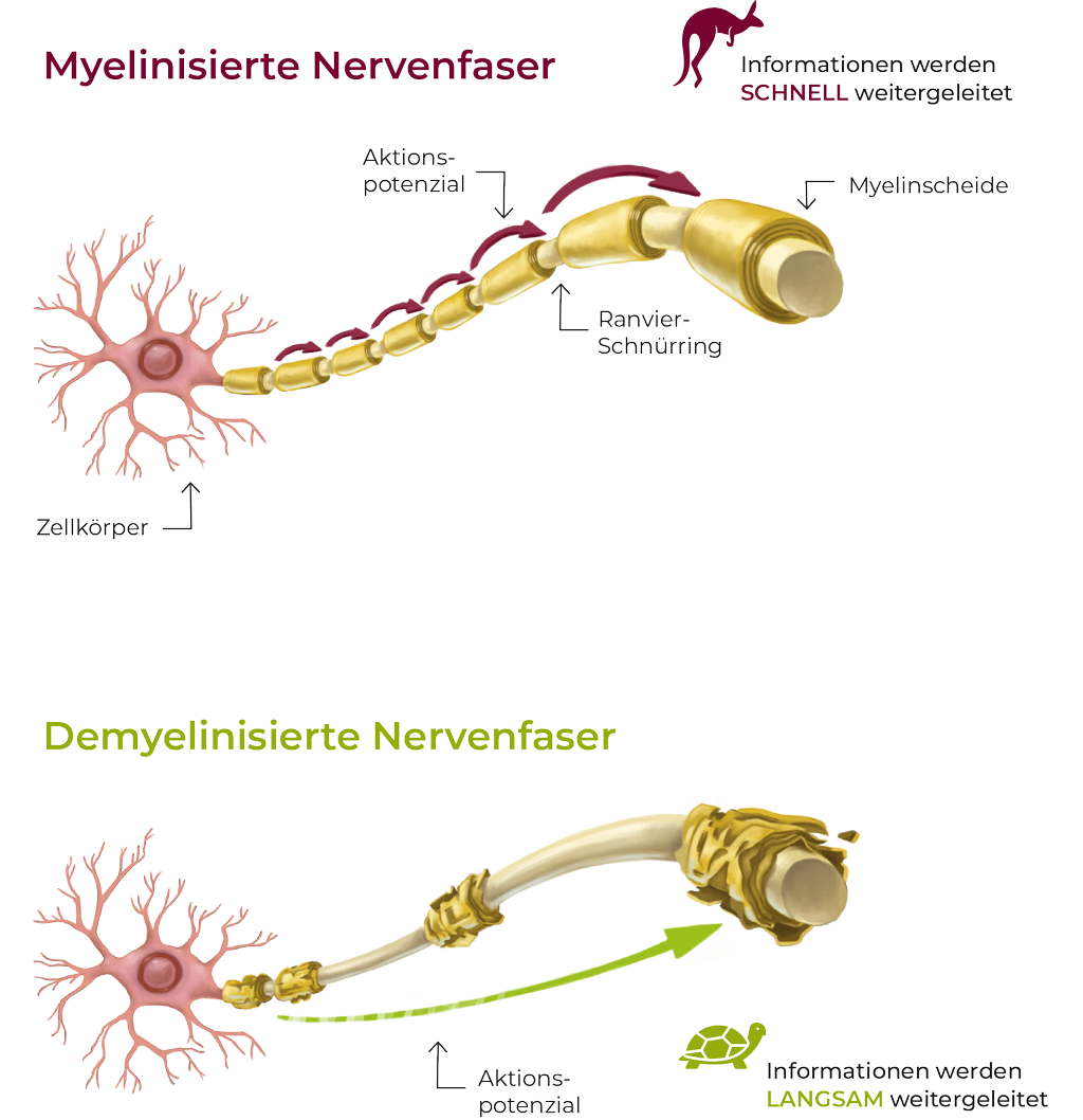 Der Unterschied zwischen myelinisierten und unmyelinisierten Nervenfasern: die Information, hier als Känguru dargestellt, kann bei intakten Nervenummantelungen schnell zwischen den „Ummantelungen“ weiterspringen. Ist die Ummantelung dagegen durch die Entzündungsprozesse der CIDP angegriffen, werden die Informationen entlang der Nervenbahnen in Schildkröten-Tempo übermittelt.